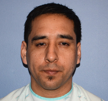 before nose rhinoplasty front view