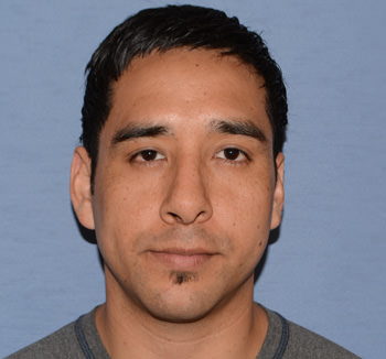 after nose rhinoplasty front view
