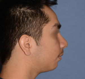 Rhinoplasty