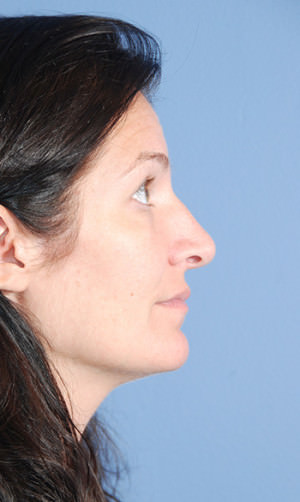 Rhinoplasty