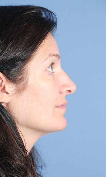 Rhinoplasty Results Bellevue