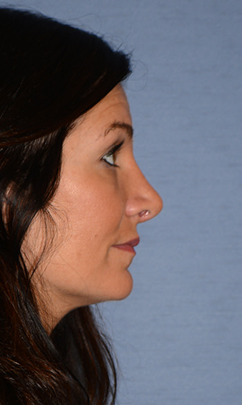 Side Profile After Rhinoplasty