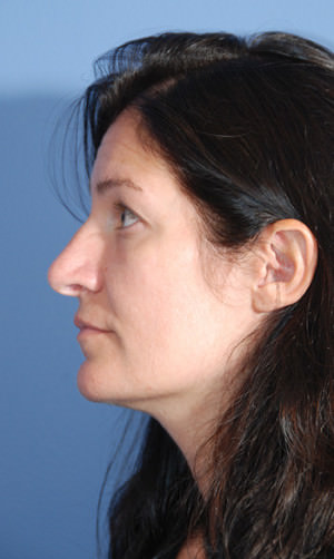 Rhinoplasty