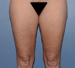 Thigh Lift