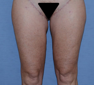 Thigh Lift