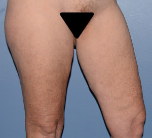 Thigh Lift