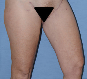 Thigh Lift