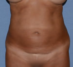 Tummy Tuck