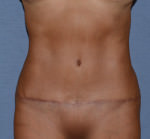 Tummy Tuck