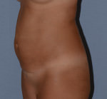 Tummy Tuck