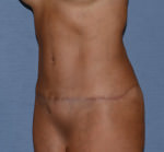 Tummy Tuck