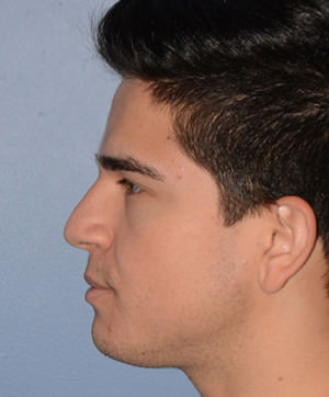 Rhinoplasty