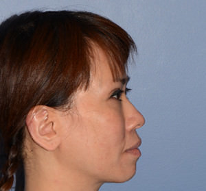 Facial Fat Transfer