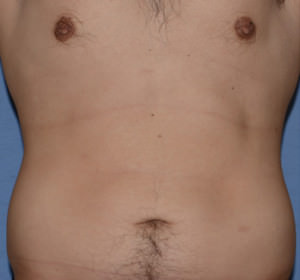 Liposuction