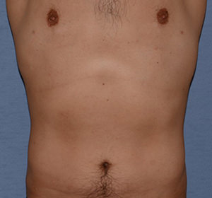 Liposuction