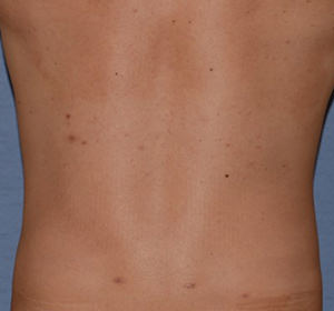 Liposuction