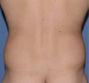 Liposuction