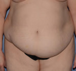 Tummy Tuck