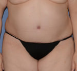Tummy Tuck