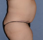 Tummy Tuck