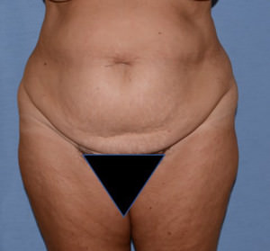 Tummy Tuck