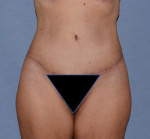 Tummy Tuck
