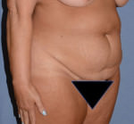 Tummy Tuck