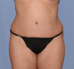 Tummy Tuck