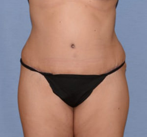 Tummy Tuck
