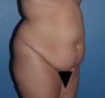 Tummy Tuck