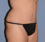 Tummy Tuck