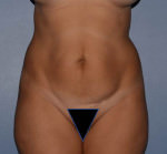 Tummy Tuck