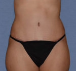 Tummy Tuck