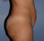 Tummy Tuck