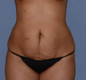 Tummy Tuck