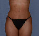 Tummy Tuck
