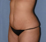 Tummy Tuck