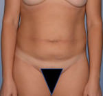Tummy Tuck