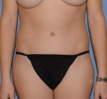 Tummy Tuck