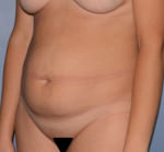 Tummy Tuck