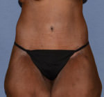 Tummy Tuck