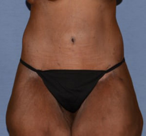 Tummy Tuck