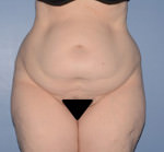 Tummy Tuck
