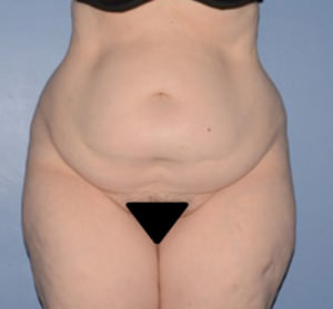 Tummy Tuck