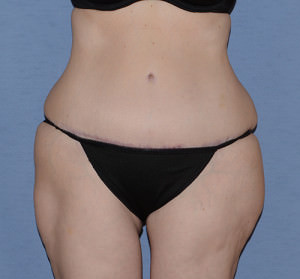 Tummy Tuck