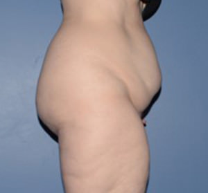 Tummy Tuck