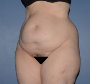 Tummy Tuck