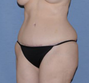 Tummy Tuck