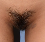 Labiaplasty