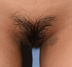 Labiaplasty